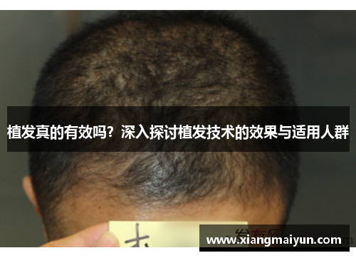 植发真的有效吗？深入探讨植发技术的效果与适用人群